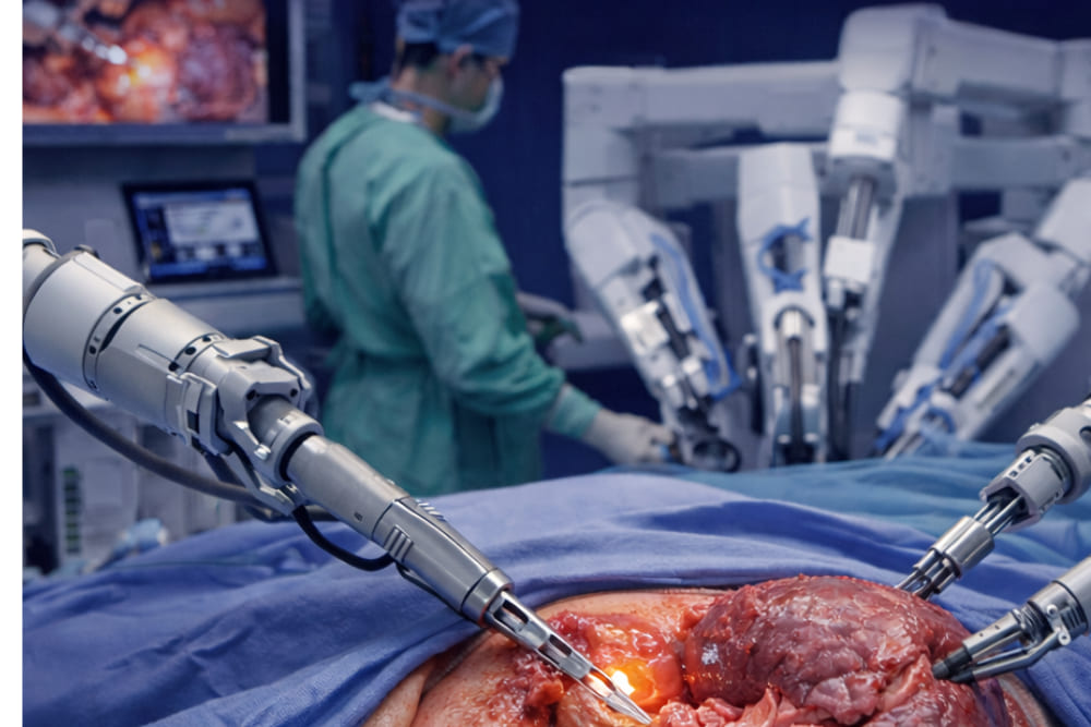 Nefrectomía parcial preservadora de nefronas laparoscópica asistida por robot Da Vinci en León de los Aldama, Gto.: Cirugía robótica de alta precisión para conservar la función renal