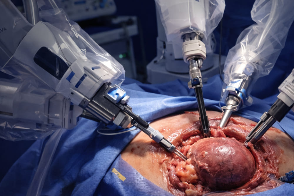 Nefrectomía radical laparoscópica asistida por robot Da Vinci en León de los Aldama, Gto.: Cirugía robótica avanzada para el tratamiento del cáncer renal
